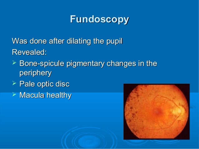 retinitis pigmentosa essay retinitis pigmentosa essay