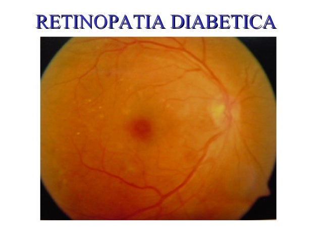 Retinopatia diabetica Retinopatia diabetica