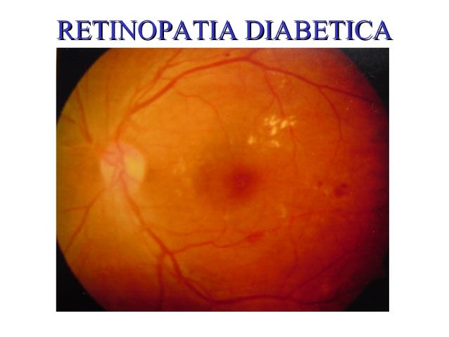 Retinopatia diabetica Retinopatia diabetica