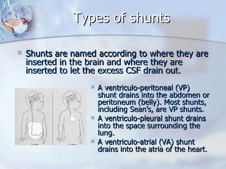 Hydrocephalus and Shunts Sean's Story