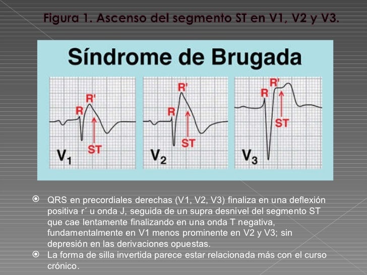 revisi-n-del-s-ndrome-de-brugada