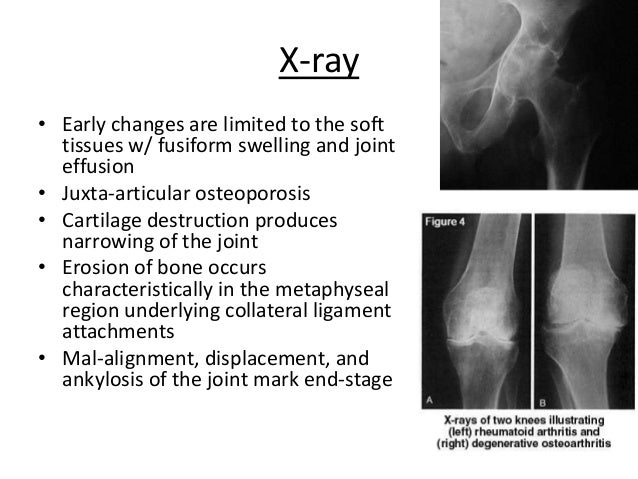 Cervical Subluxation