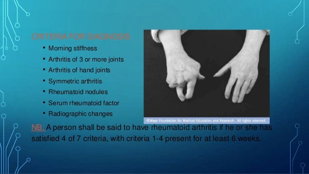 Cialis Arthritis Hand Stiffness