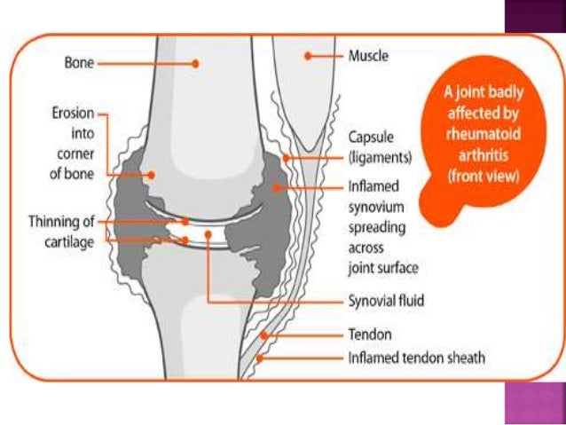2019 year - How Vitamin D Affects Rheumatoid Arthritis 2019 year