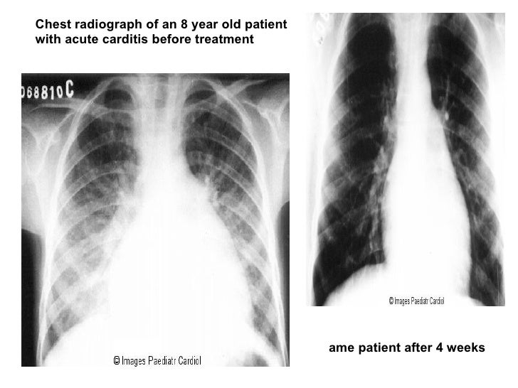 Rheumatic heart disease
