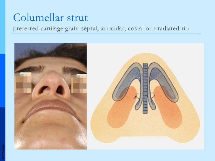 Grafts in Nasal Surgery v2