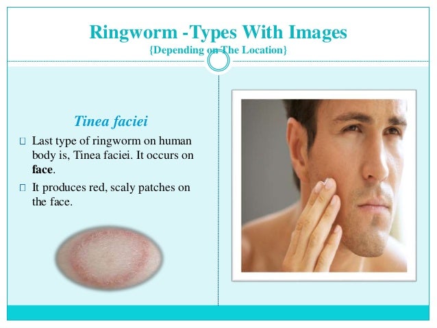 pictures of ringworms on face #10