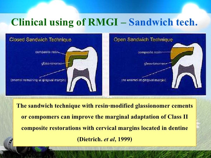 Resin Modified Glassionomer cement