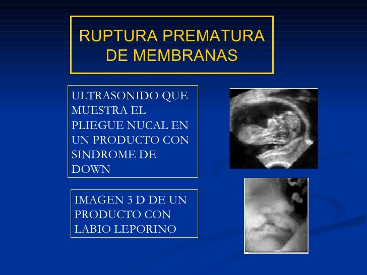Hematoma Retrocorial Y Síndrome De Down
