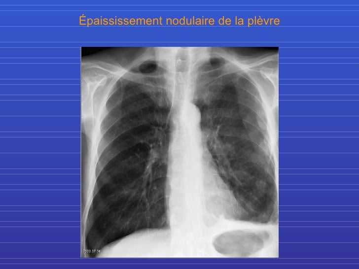 Que Veut Dire Accentuation De La Trame Bronchique