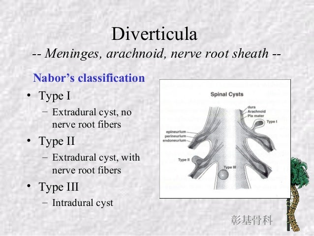 Surgical Treatment of Symptomatic Sacral Cysts