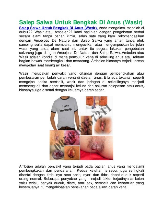 salep salwa untuk bengkak di wasir salep salwa untuk bengkak di wasir