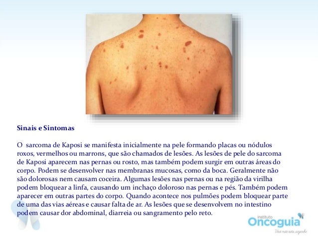 sarcoma-de-kaposi