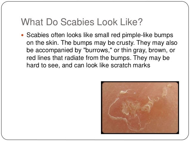 Pictures of Scabies in Babies | Pictures of Scabies