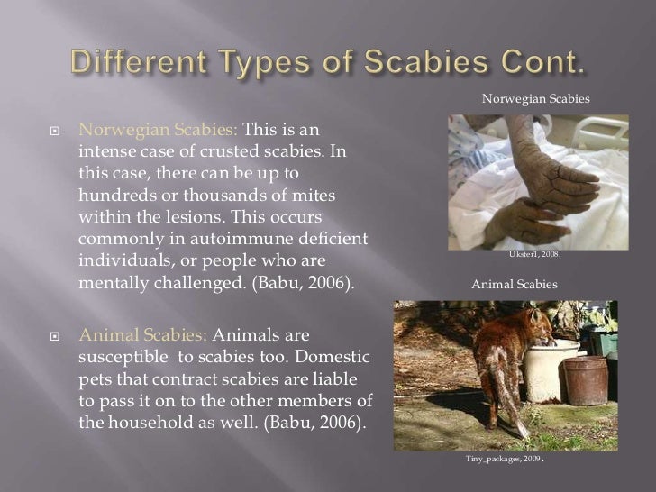 Scabies presentation 2