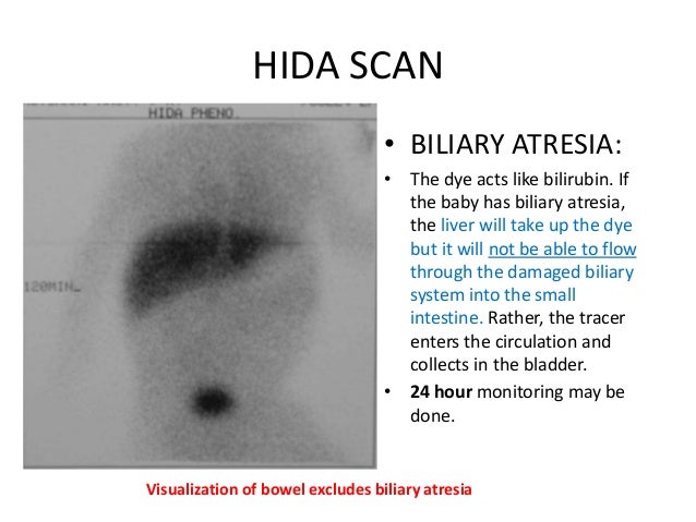 Hida ativan scan with