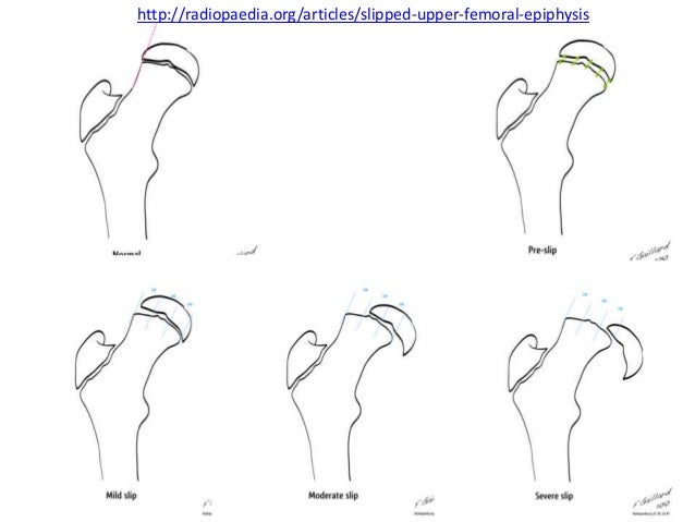 slipped capital femoral epithesis Diagnosed with slipped capital femoral epiphysis of the hip, 12-year-old zachary faced life-long disability thanks to a specialized surgery available at the children. slipped capital femoral epithesis Diagnosed with slipped capital femoral epiphysis of the hip, 12-year-old zachary faced life-long disability thanks to a specialized surgery available at the children.