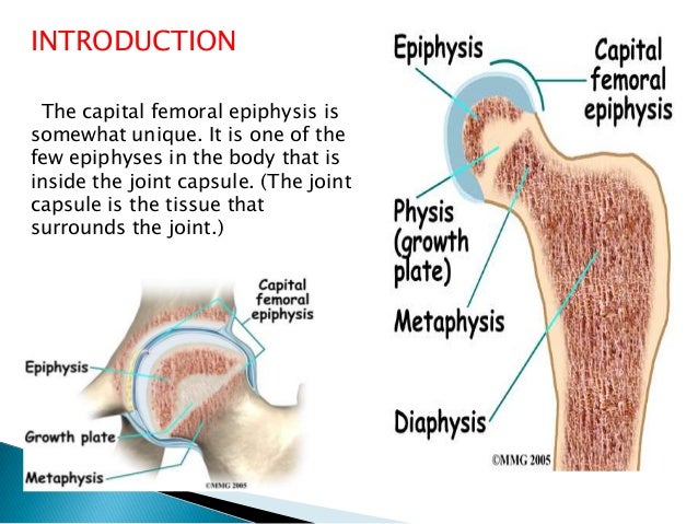 slipped capital femoral epiphysis essay slipped capital femoral epiphysis essay