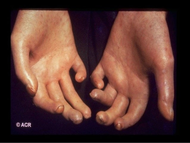 Sclerodactylie - 3 definities - Encyclo