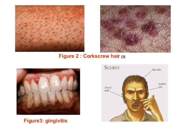 Scurvy | Genetic and Rare Diseases Information Center ...