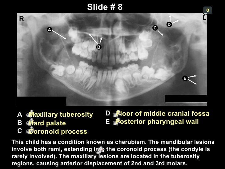 Domestic remedies for treating sinus congestion sinus infection sore roof of mouth