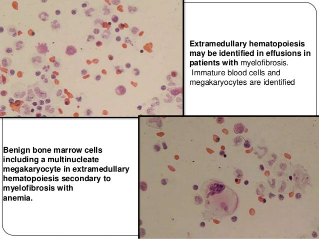 Mesothelioma Psammoma Bodies
