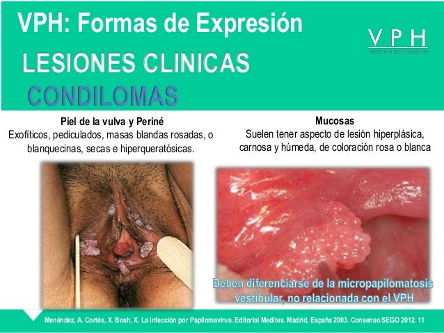 Cancer l.  A. Cervix