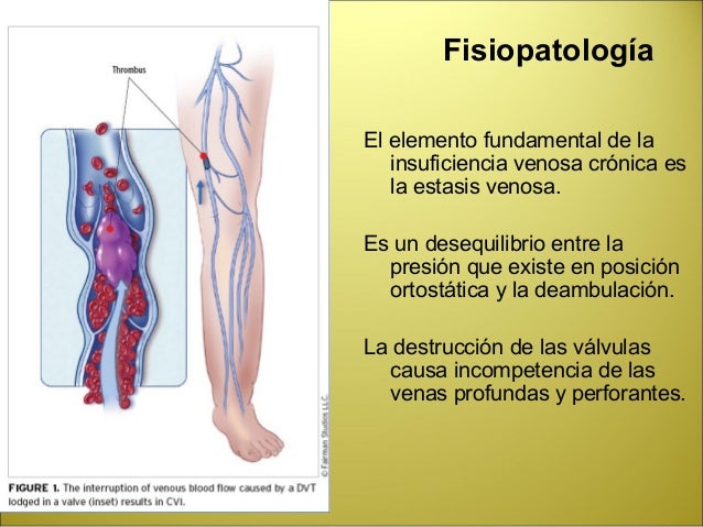Que tal la trombosis delgado el intestino