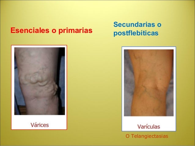 Los medios para el tratamiento varicoso
