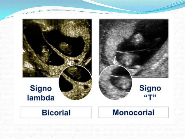 Signo De La T Embarazo Gemelar
