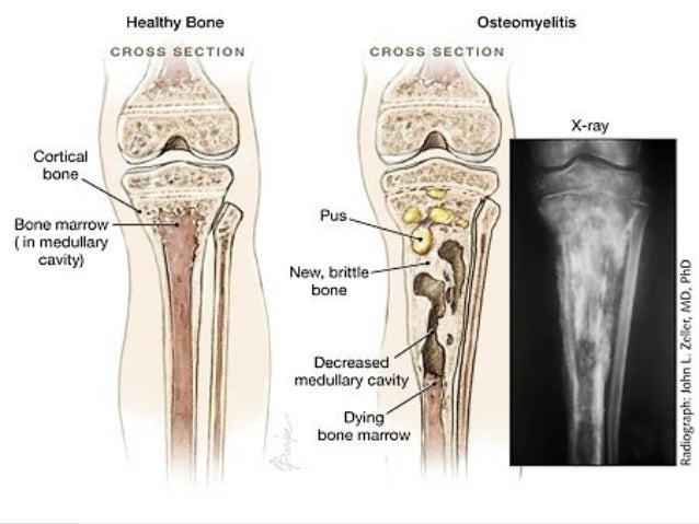 "Osteomyelitis" ile ilgili görsel sonucu