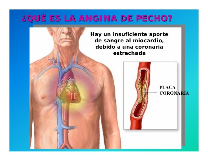 semiologa-de-la-angina-de-pecho-3-728.jpg (728×563)