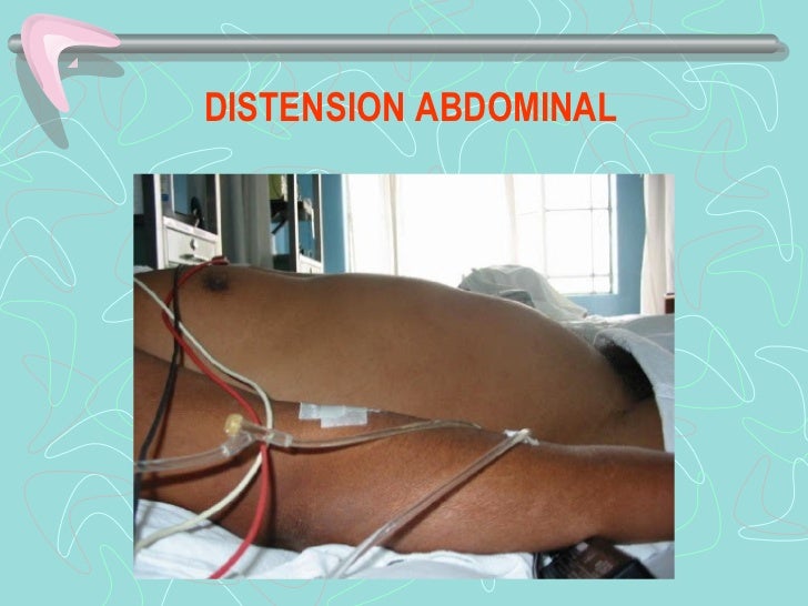 DISTENSION ABDOMINAL 