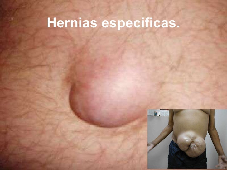 La hernia intervertebral por el complot