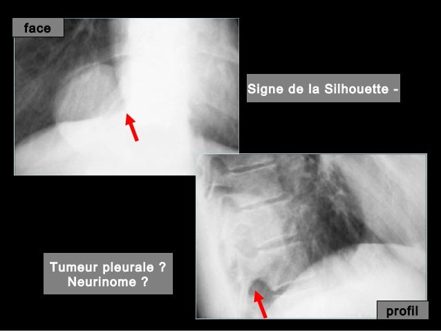 leucémie et lymphome