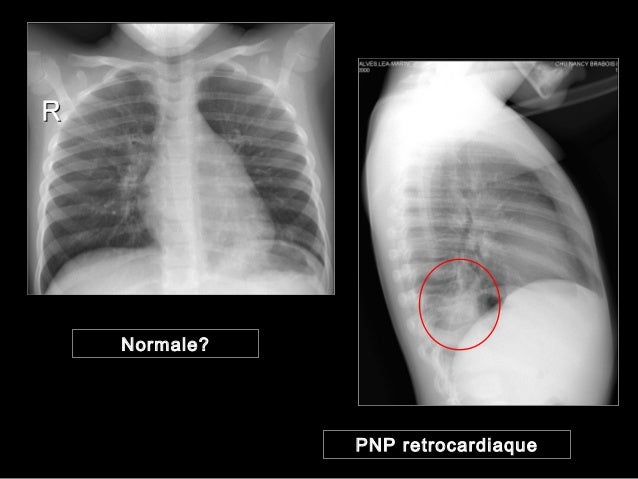 most cancers de seine traitement