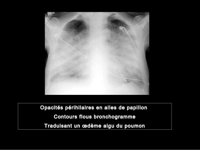 Most cancers Poumon Radio Normale