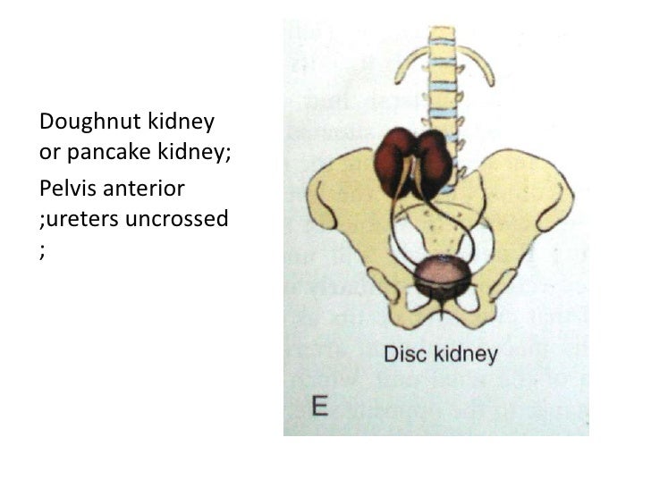A Case of Horseshoe Kidney