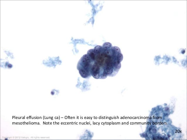 Mesothelioma Pleural Effusion Cytology