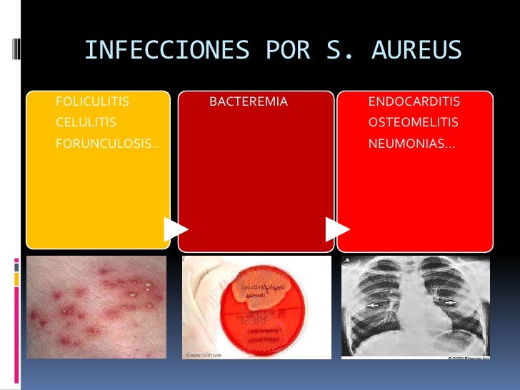 Staphylococcus Aureus