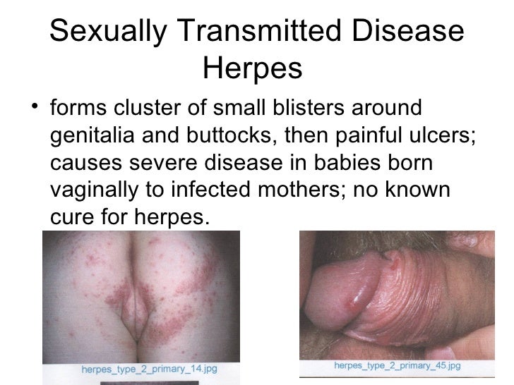 Genital Herpes | Herpes Symptoms | Herpes Simplex ...