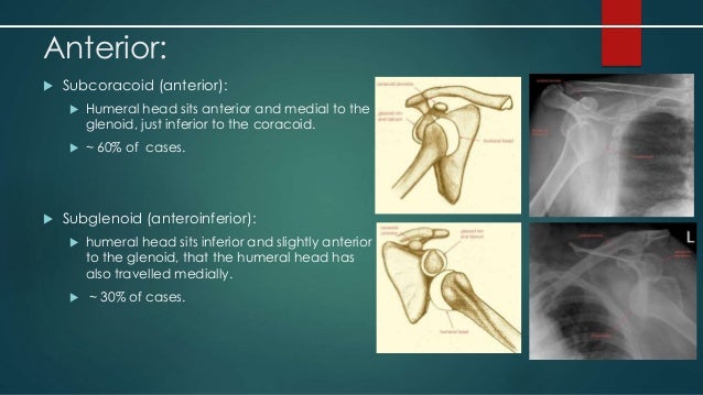How to Prevent Shoulder Dislocation advise How to Prevent Shoulder Dislocation advise