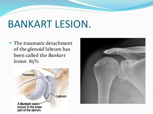 slap tear