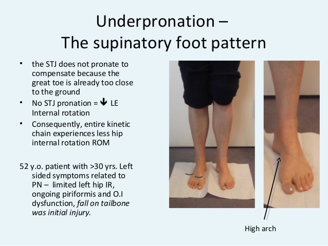 under pronation of foot