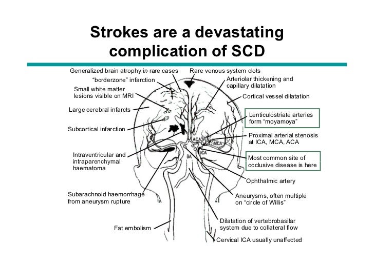 What artery blockage reasons a lacunar stroke silent stroke nhs