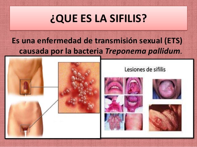 ENFERMEDAD DE TRANSMISION SEXUAL SIFILIS enfermedad de transmision sexual sifilis: