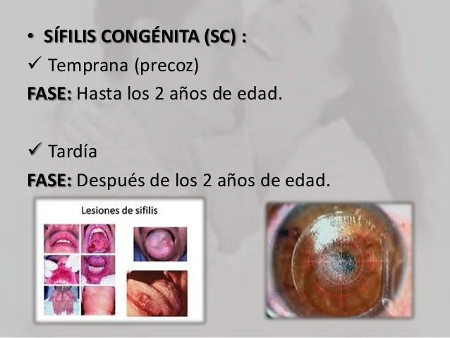 Sifilis (2)