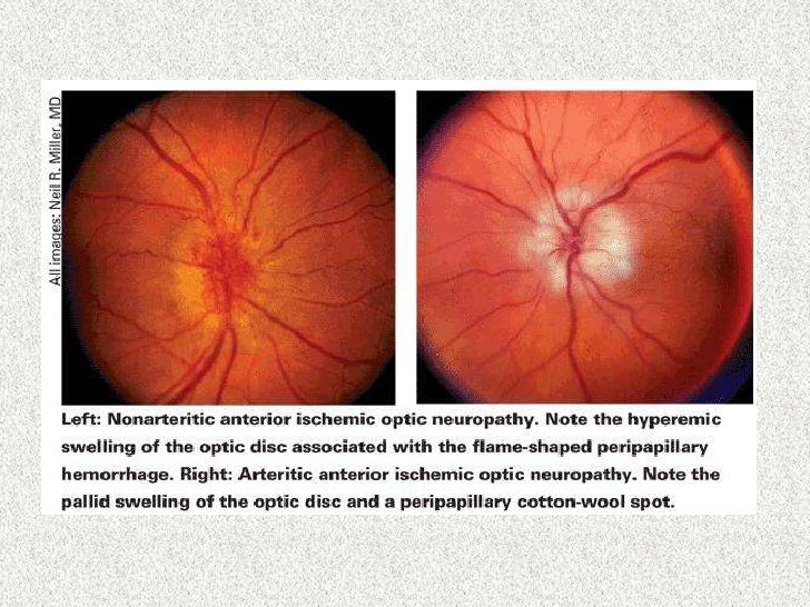 Signos del disco óptico y neuropatías ópticas
