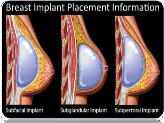 Breast Implants String 32