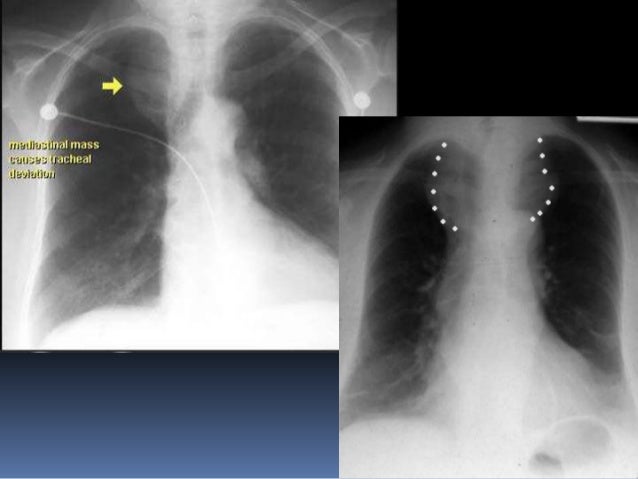 thyroid slide
